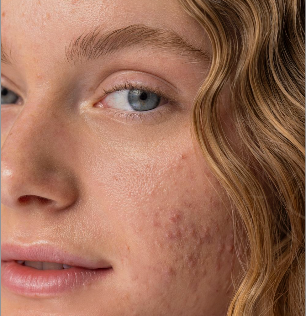 LED Terapie Světlem vs. Akné: všechny výhody a jak to funguje